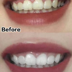 Whitening effect before and after 1