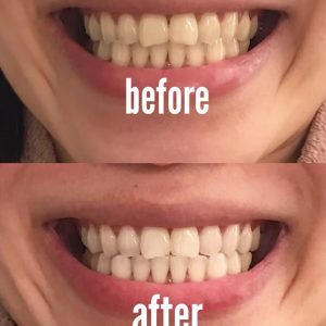 Whitening effect before and after